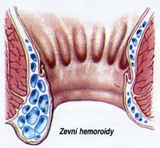 hemeroidy 3